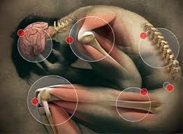 Fibromialgia agora é considerada deficiência