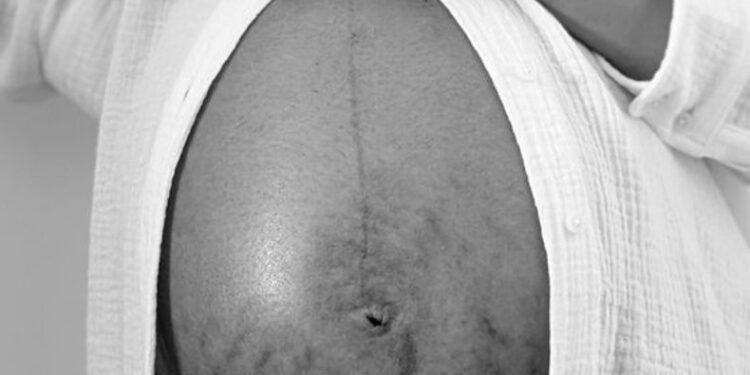 Estrias: quando a pele conta histórias e como a Estetica pode reescreve-las?
